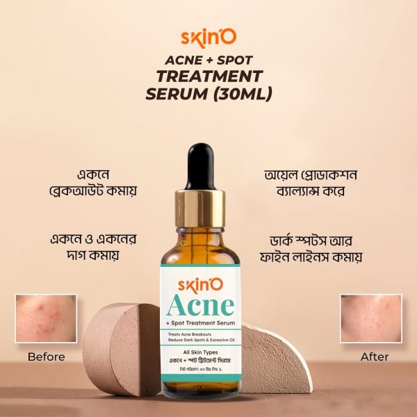 Acne Serum
